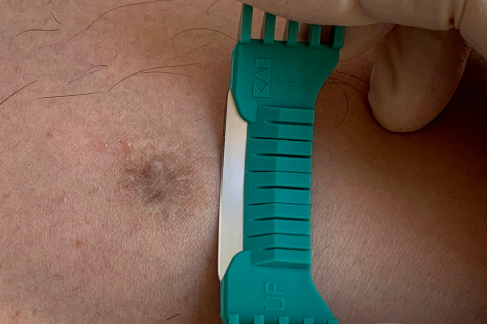 Shave biopsies