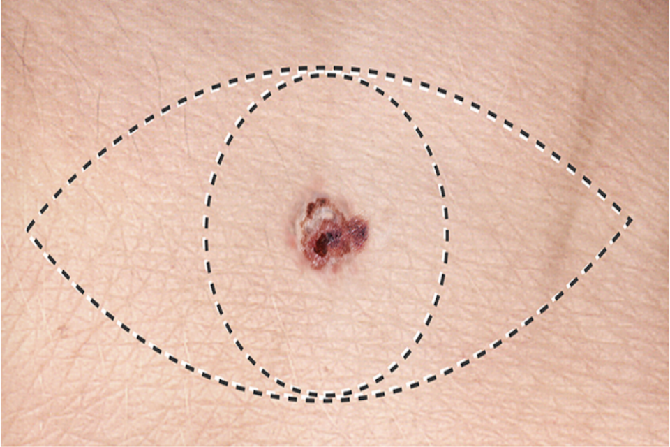Diagram showing Wide Local Excision to remove potential microscopic melanoma cells around the tumour to prevent recurrence